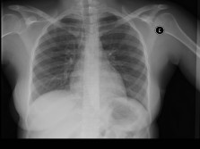Lungs